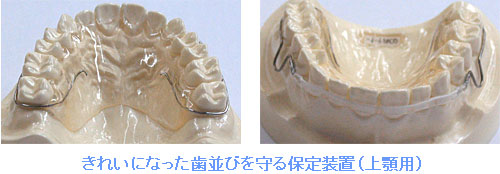 きれいになった歯並びを守る保定装置（上顎用）