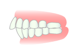 上顎前突−出っ歯
