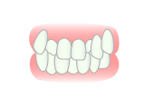 叢生(そうせい)−八重歯・乱ぐい歯