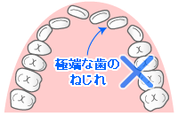 極端な歯のねじれ