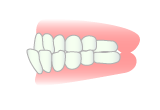 下顎前突−受け口・反対咬合
