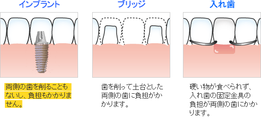 前歯を一本失った場合