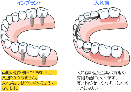 奥歯を数本失った場合