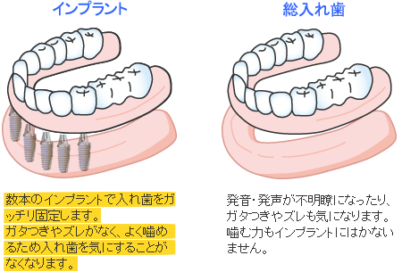 すべての歯がない総入れ歯の場合