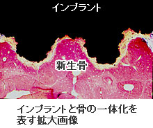 オッセオインテグレーション