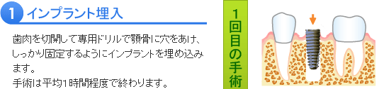 インプラント治療の流れ１