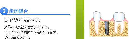 インプラント治療の流れ２