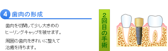 インプラント治療の流れ４