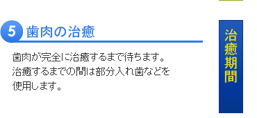 インプラント治療の流れ５