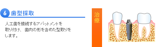 インプラント治療の流れ６