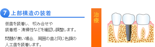 インプラント治療の流れ７