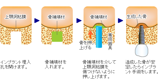 ソケットリフト法