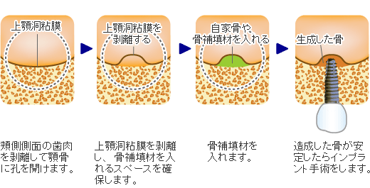 サイナスリフト法