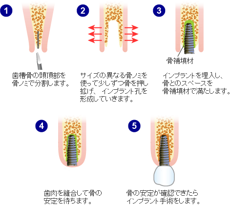 スプリットクレスト法