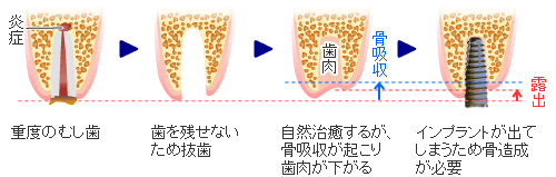 骨誘導再生療法（GBR法）