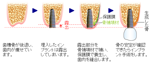 インプラント手術と同時に骨の再生