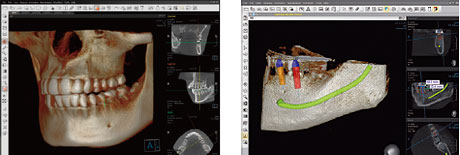 ＣＴスキャンによる３Ｄ表示、およびインプラント治療計画例